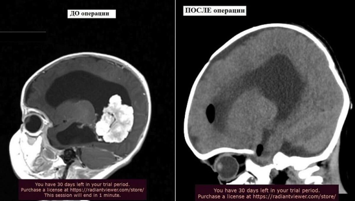 Столичные врачи удалили огромную опухоль мозга у двухмесячного ребенка